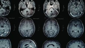 Medical equipment manufacturer Neurolief partner with Metric for placement of new CEO