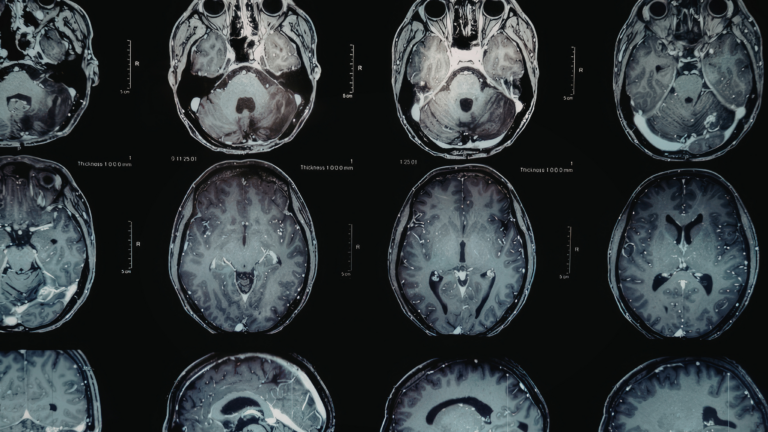 Medical equipment manufacturer Neurolief partner with Metric for placement of new CEO